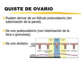 QUISTE DE OVARIO
Pueden derivar de un folículo preovulatorio (sin
luteinización de la pared).
De uno postovulatorio (con...