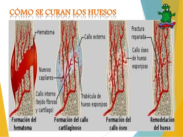 Formacion Del Callo Oseo En Una Fractura