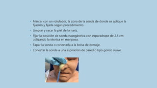• Marcar con un rotulador, la zona de la sonda de donde se aplique la
fijación y fijarla según procedimiento.
• Limpiar y secar la piel de la nariz.
• Fijar la posición de sonda nasogástrica con esparadrapo de 2.5 cm
utilizando la técnica en mariposa.
• Tapar la sonda o conectarla a la bolsa de drenaje.
• Conectar la sonda a una aspiración de pared o tipo gonco suave.
 