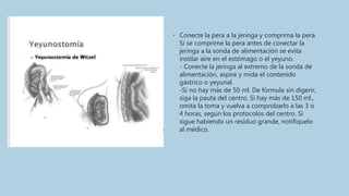 • Conecte la pera a la jeringa y comprima la pera.
Si se comprime la pera antes de conectar la
jeringa a la sonda de alimentación se evita
instilar aire en el estómago o el yeyuno.
- Conecte la jeringa al extremo de la sonda de
alimentación, aspire y mida el contenido
gástrico o yeyunal.
-Si no hay más de 50 ml. De fórmula sin digerir,
siga la pauta del centro. Si hay más de 150 ml.,
omita la toma y vuelva a comprobarlo a las 3 o
4 horas, según los protocolos del centro. Si
sigue habiendo un residuo grande, notifíquelo
al médico.
 