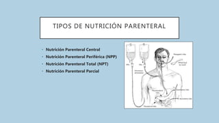 TIPOS DE NUTRICIÓN PARENTERAL
• Nutrición Parenteral Central
• Nutrición Parenteral Periférica (NPP)
• Nutrición Parenteral Total (NPT)
• Nutrición Parenteral Parcial
 