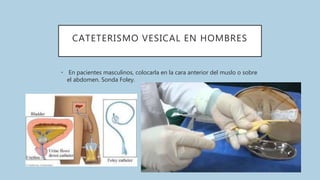 CATETERISMO VESICAL EN HOMBRES
• En pacientes masculinos, colocarla en la cara anterior del muslo o sobre
el abdomen. Sonda Foley.
 