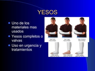 YESOS Uno de los materiales mas usados Yesos completos o valvas Uso en urgencia y tratamientos 