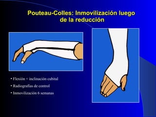 Pouteau-Colles: Inmovilización luego  de la reducción Flexión + inclinación cubital Radiografías de control Inmovilización 6 semanas 