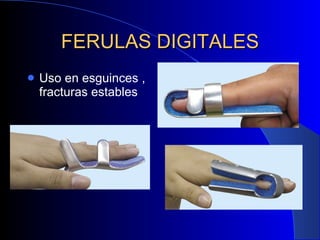 FERULAS DIGITALES Uso en esguinces , fracturas estables 