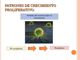 PATRONES DE CRECIMIENTO PROLIFERATIVO: Pérdida del control sobre el crecimiento Neoplásico No neoplásico 