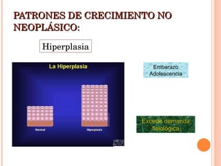 PATRONES DE CRECIMIENTO NO NEOPLÁSICO: Hiperplasia Excede demanda fisiológica Embarazo Adolescencia 