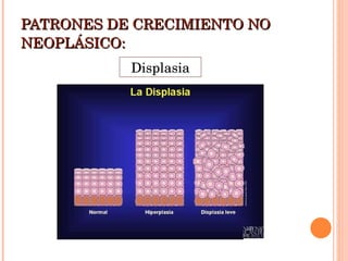 PATRONES DE CRECIMIENTO NO NEOPLÁSICO: Displasia 