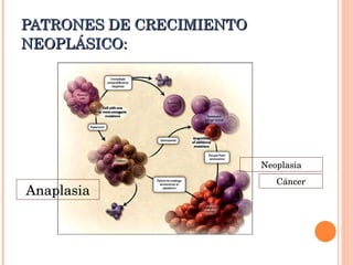PATRONES DE CRECIMIENTO NEOPLÁSICO: Cáncer Anaplasia Neoplasia 