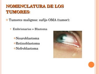 NOMENCLATURA DE LOS TUMORES : Tumores malignos: sufijo OMA (tumor): Embrionarios = Blastoma Neuroblastoma Retinoblastoma Nefroblastoma 