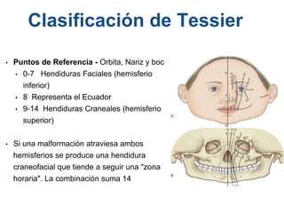 • Puntos de Referencia - Orbita, Nariz y boca
• 0-7 Hendiduras Faciales (hemisferio
inferior)
• 8 Representa el Ecuador
• 9-14 Hendiduras Craneales (hemisferio
superior)
• Si una malformación atraviesa ambos
hemisferios se produce una hendidura
craneofacial que tiende a seguir una "zona
horaria". La combinación suma 14
Clasificación de Tessier
 
