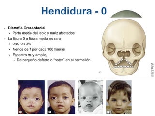 • Disrrafia Craneofacial
• Parte media del labio y nariz afectados
• La fisura 0 o fisura media es rara
• 0.40-0.70%
• Menos de 1 por cada 100 fisuras
• Espectro muy amplio,
• De pequeño defecto o “notch” en el bermellón
Hendidura - 0
 