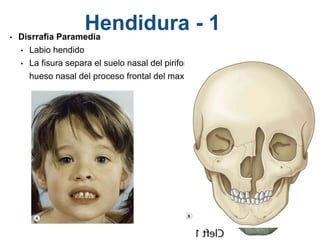 Hendidura - 1• Disrrafia Paramedia
• Labio hendido
• La fisura separa el suelo nasal del piriforme y el
hueso nasal del proceso frontal del maxilar
 