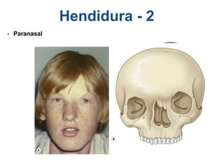 Hendidura - 2
• Paranasal
 