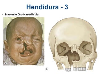 Hendidura - 3
• Involucio Oro-Naso-Ocular
 