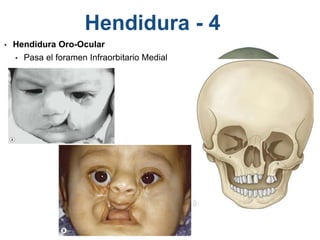 Hendidura - 4
• Hendidura Oro-Ocular
• Pasa el foramen Infraorbitario Medial
 