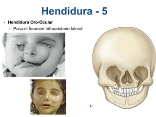 Hendidura - 5
• Hendidura Oro-Ocular
• Pasa el foramen Infraorbitario lateral
 