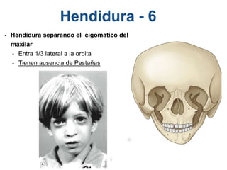 Hendidura - 6
• Hendidura separando el cigomatico del
maxilar
• Entra 1/3 lateral a la orbita
• Tienen ausencia de Pestañas
 