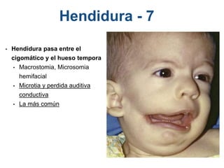 Hendidura - 7
• Hendidura pasa entre el
cigomático y el hueso temporal
• Macrostomia, Microsomia
hemifacial
• Microtia y perdida auditiva
conductiva
• La más común
 