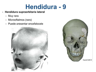 Hendidura - 9
• Hendidura supraorbitaria lateral
• Muy rara
• Microoftalmos (raro)
• Puede presentar encefalocele
 