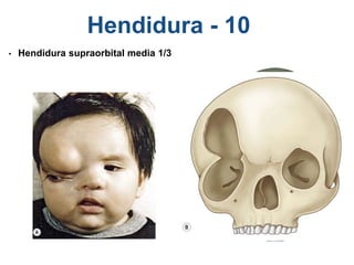 Hendidura - 10
• Hendidura supraorbital media 1/3
 