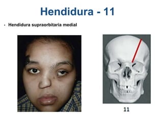 Hendidura - 11
• Hendidura supraorbitaria medial
 
