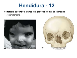 Hendidura - 12
• Hendidura pasando a través del proceso frontal de la maxila
• Hipertelorismo
 