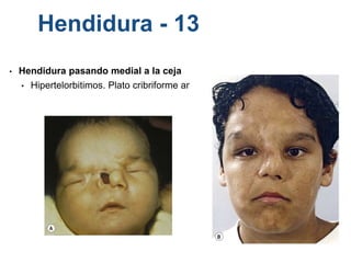 Hendidura - 13
• Hendidura pasando medial a la ceja
• Hipertelorbitimos. Plato cribriforme amplio
 