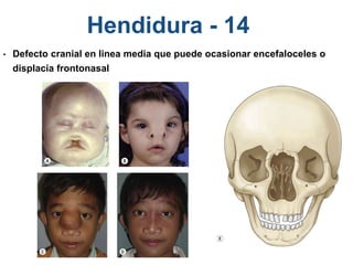 Hendidura - 14
• Defecto cranial en linea media que puede ocasionar encefaloceles o
displacía frontonasal
 