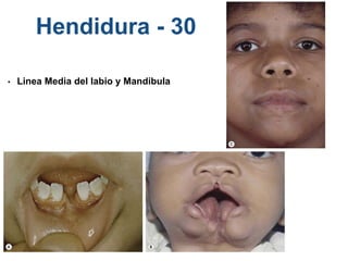 Hendidura - 30
• Linea Media del labio y Mandibula
 