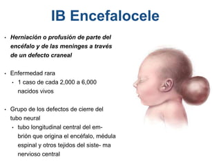 • Herniación o profusión de parte del
encéfalo y de las meninges a través
de un defecto craneal
• Enfermedad rara
• 1 caso de cada 2,000 a 6,000
nacidos vivos
• Grupo de los defectos de cierre del
tubo neural
• tubo longitudinal central del em-
brión que origina el encéfalo, médula
espinal y otros tejidos del siste- ma
nervioso central
IB Encefalocele
 