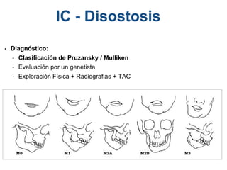 • Diagnóstico:
• Clasificación de Pruzansky / Mulliken
• Evaluación por un genetista
• Exploración Física + Radiografias + TAC
IC - Disostosis
 