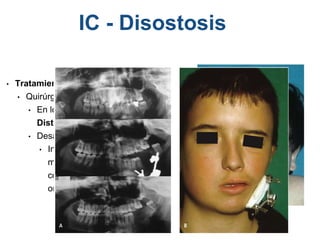 • Tratamiento:
• Quirúrgico y Multidiciplinario
• En los primero meses de la vida -
Distracción Osea
• Desarrollo completo del macizo facial
• Injertos óseos, colgajos libres
microvascularizados del tipo
compuesto o bien cirugía
ortognática
IC - Disostosis
 
