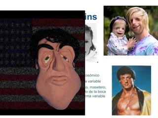 Treacher Collins
Dominante autosómico
Expresión de la variable
Arco zigomático, masetero,
mandíbula, lado de la boca
afectado de forma variable
 