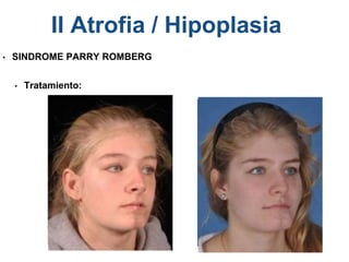 • SINDROME PARRY ROMBERG
• Tratamiento:
II Atrofia / Hipoplasia
 