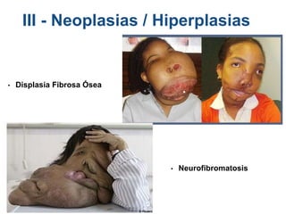 • Displasia Fibrosa Ósea
III - Neoplasias / Hiperplasias
• Neurofibromatosis
 