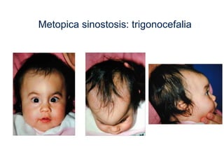 Metopica sinostosis: trigonocefalia
 