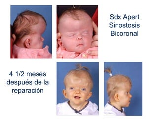 4 1/2 meses
después de la
reparación
Sdx Apert
Sinostosis
Bicoronal
 