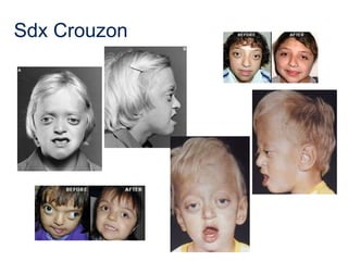 Sdx Crouzon
 