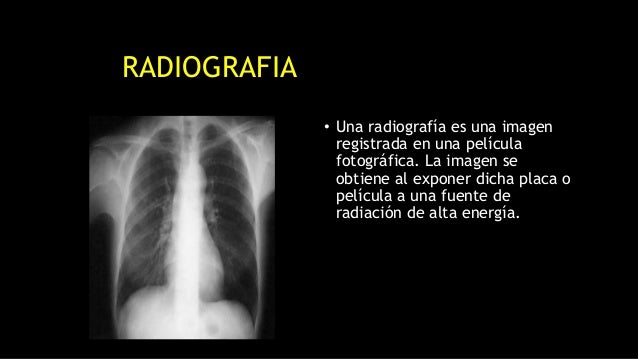 RADIOGRAFIA
â€¢ Una radiografÃ­a es una imagen
registrada en una pelÃ­cula
fotogrÃ¡fica. La imagen se
obtiene al exponer dicha ...