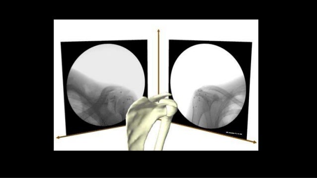 Perforación intestinal