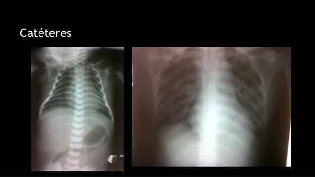 Ventajas y desventajas TC