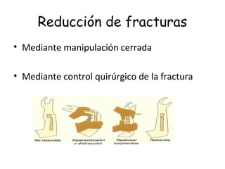 Reducción de fracturas
• Mediante manipulación cerrada
• Mediante control quirúrgico de la fractura
 