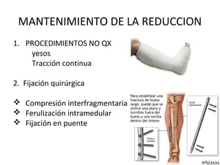 MANTENIMIENTO DE LA REDUCCION
1. PROCEDIMIENTOS NO QX
yesos
Tracción continua
2. Fijación quirúrgica
 Compresión interfragmentaria
 Ferulización intramedular
 Fijación en puente
 