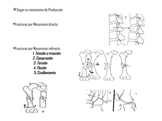 Según su mecanismo de Producción
Fracturas por Mecanismo directo
Fracturas por Mecanismo indirecto
1. Tensión o tracción
2. Compresión
3. Torsión
4. Flexión
5. Cizallamiento
 