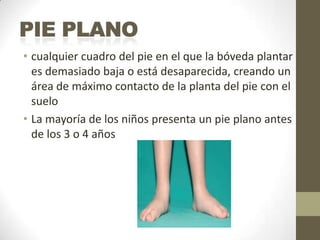 • cualquier cuadro del pie en el que la bóveda plantar
  es demasiado baja o está desaparecida, creando un
  área de máximo contacto de la planta del pie con el
  suelo
• La mayoría de los niños presenta un pie plano antes
  de los 3 o 4 años
 