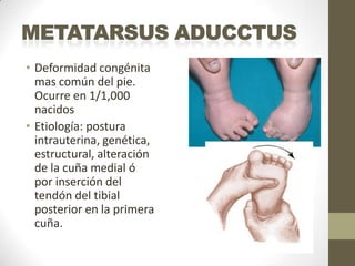 • Deformidad congénita
  mas común del pie.
  Ocurre en 1/1,000
  nacidos
• Etiología: postura
  intrauterina, genética,
  estructural, alteración
  de la cuña medial ó
  por inserción del
  tendón del tibial
  posterior en la primera
  cuña.
 