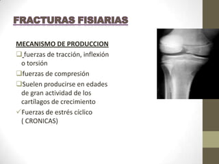 MECANISMO DE PRODUCCION
 fuerzas de tracción, inflexión
 o torsión
fuerzas de compresión
Suelen producirse en edades
 de gran actividad de los
 cartílagos de crecimiento
Fuerzas de estrés cíclico
 ( CRONICAS)
 
