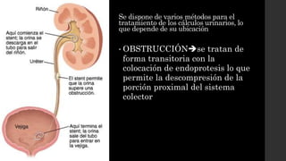 Se dispone de varios métodos para el
tratamiento de los cálculos urinarios, lo
que depende de su ubicación
• OBSTRUCCIÓNse tratan de
forma transitoria con la
colocación de endoprotesis lo que
permite la descompresión de la
porción proximal del sistema
colector
 