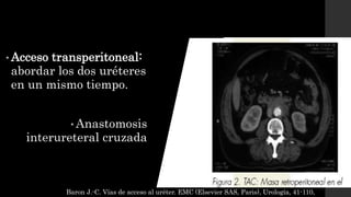 • Acceso transperitoneal:
abordar los dos uréteres
en un mismo tiempo.
• Anastomosis
interureteral cruzada
Baron J.-C. Vías de acceso al uréter. EMC (Elsevier SAS, Paris), Urología, 41-110,
 